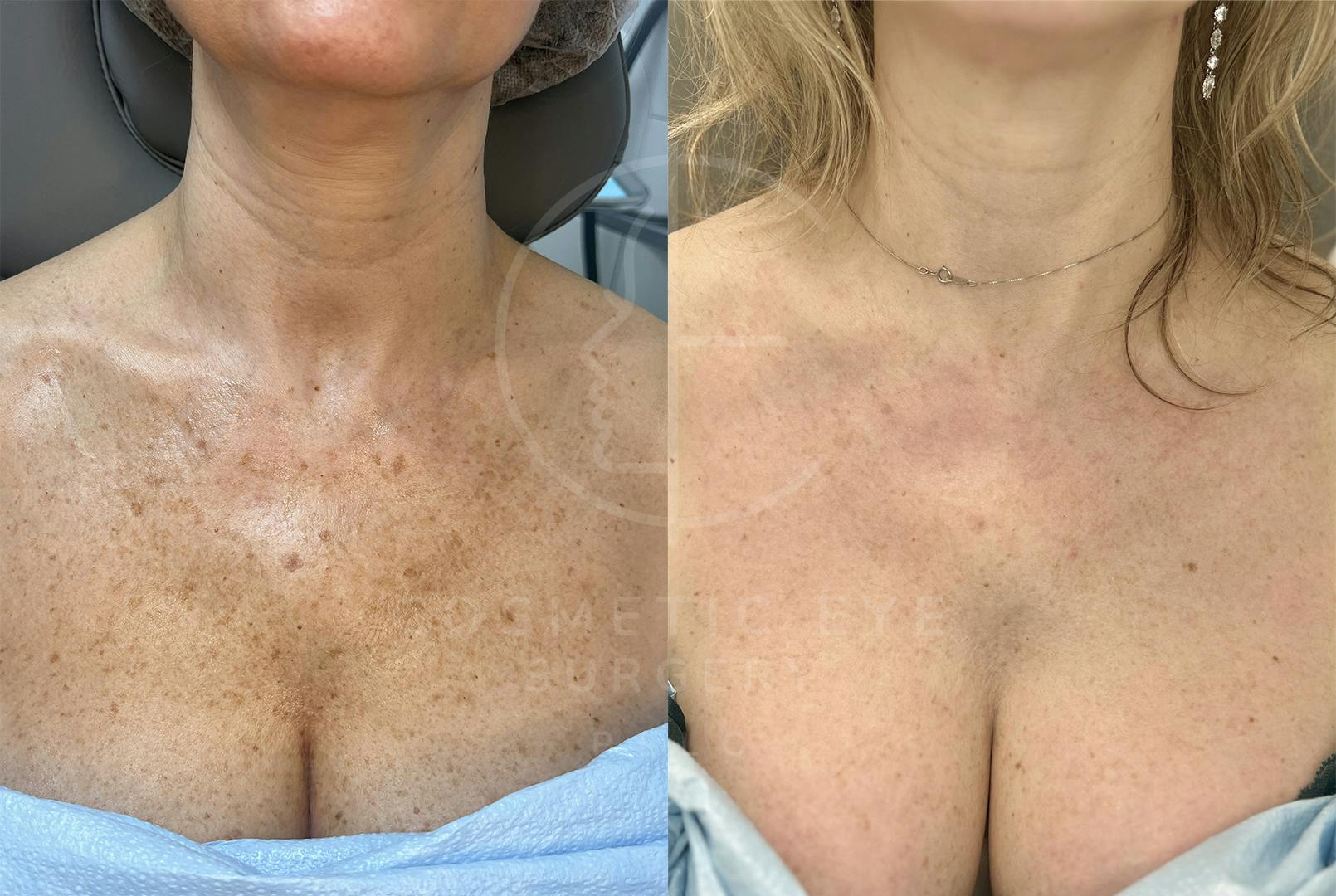 CO₂ LASER Treatment for Sun-Damaged Décolletage Patient Image #1