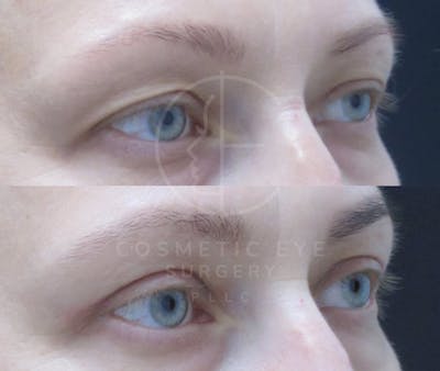 Cosmetic Eye Gallery Before & After Gallery - Patient 286349 - Image 1