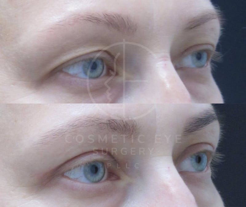 Cosmetic Eye Gallery Before & After Gallery - Patient 286349 - Image 1