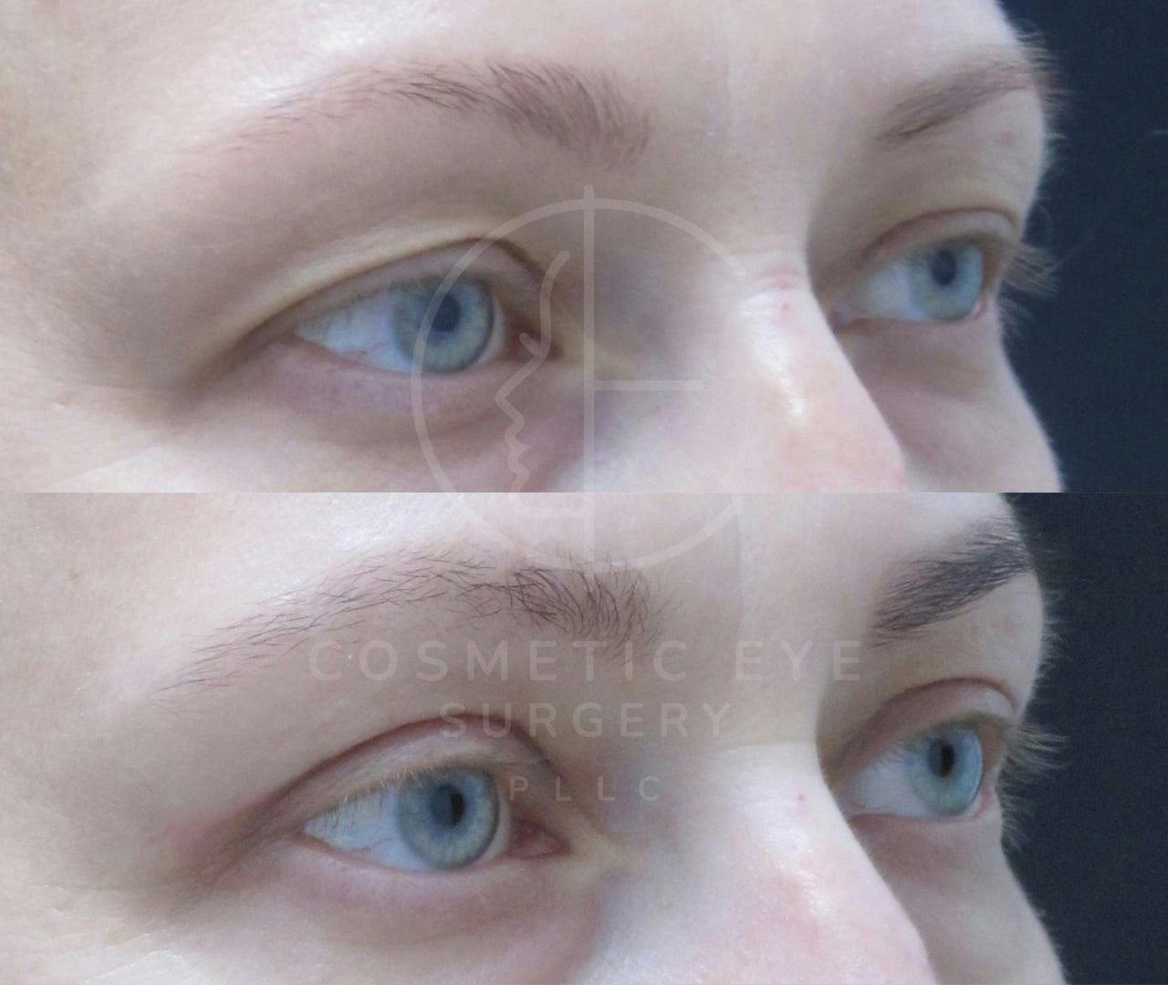 Upper Blepharoplasty Patient Image #1
