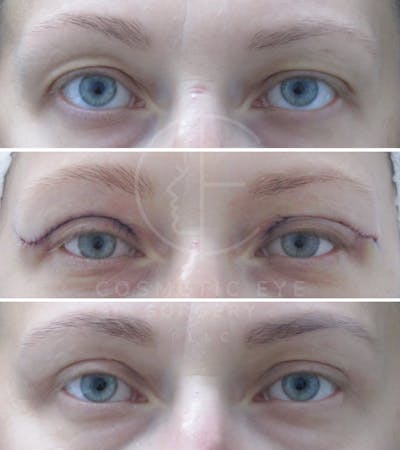 Cosmetic Eye Gallery Before & After Gallery - Patient 286349 - Image 2