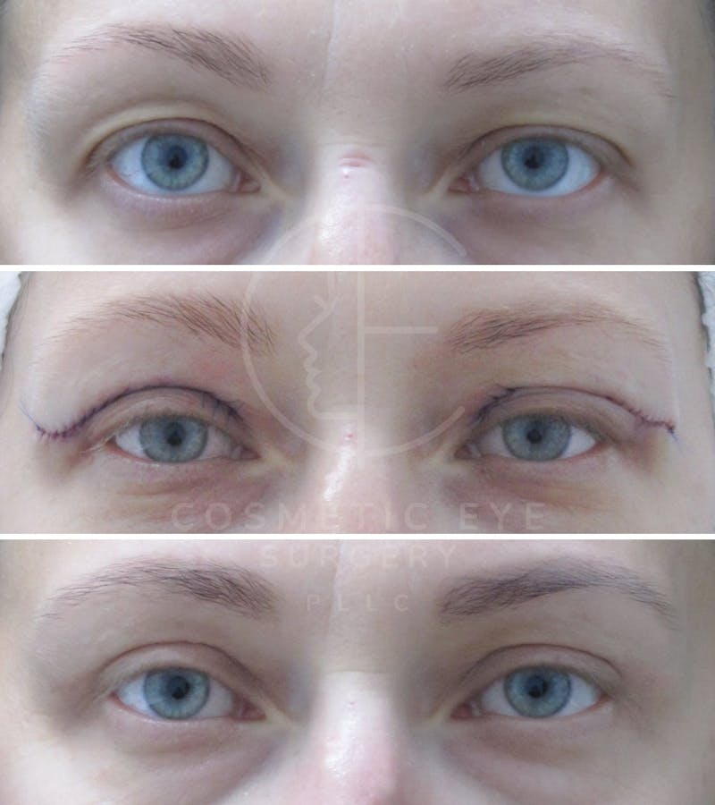 Cosmetic Eye Gallery Before & After Gallery - Patient 286349 - Image 2