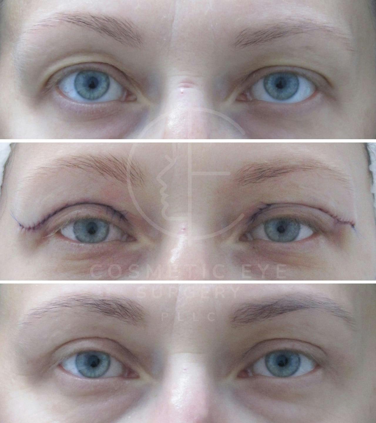 Upper Blepharoplasty Patient Image #2
