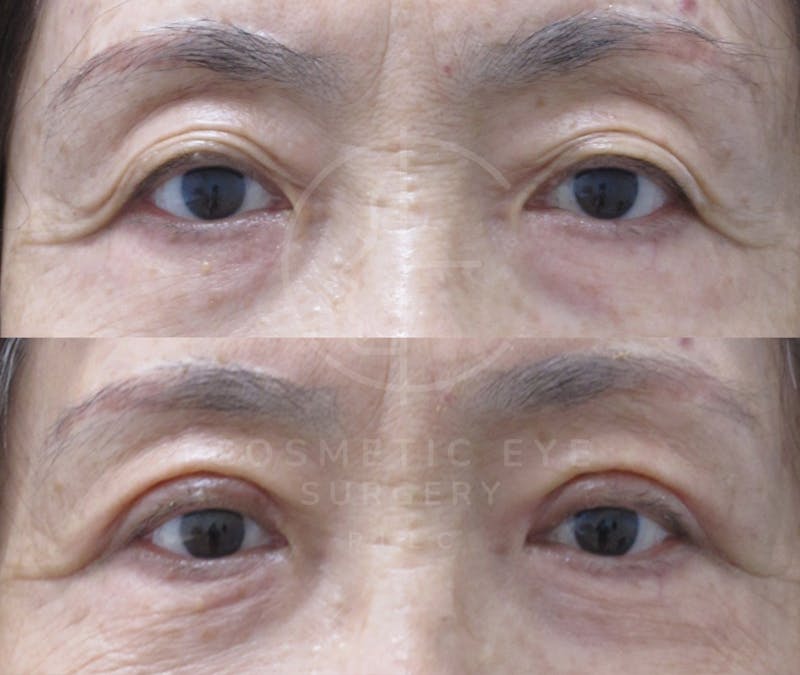 Cosmetic Eye Gallery Before & After Gallery - Patient 115776 - Image 3