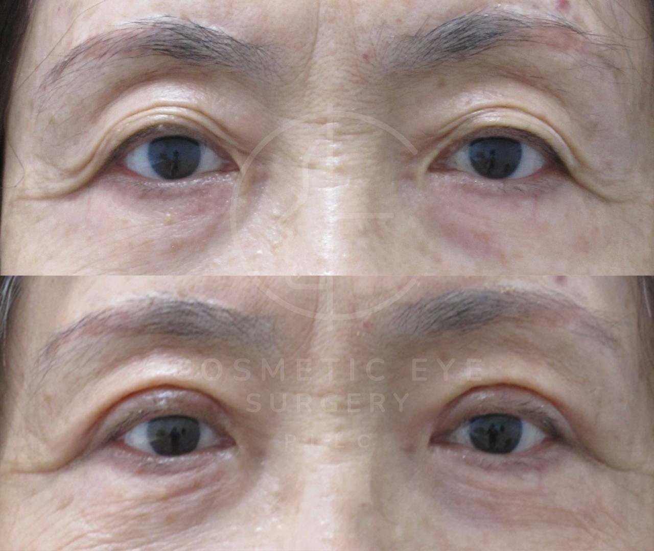 Asian Eyelids Blepharoplasty Patient Image #3