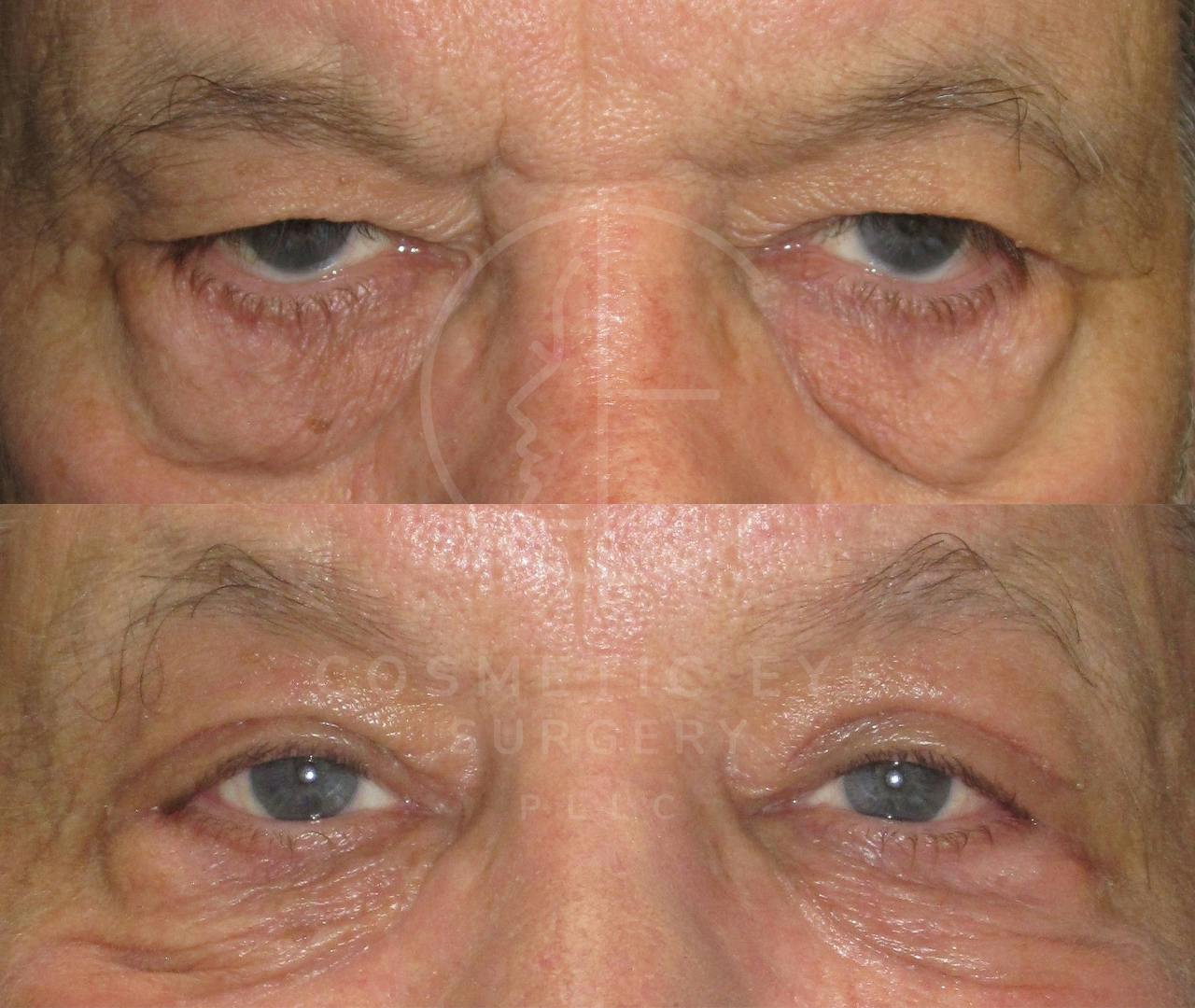 Male Lower Eyelids Ectropion Repair, Canthoplasty & Upper Bleph Patient Image #2