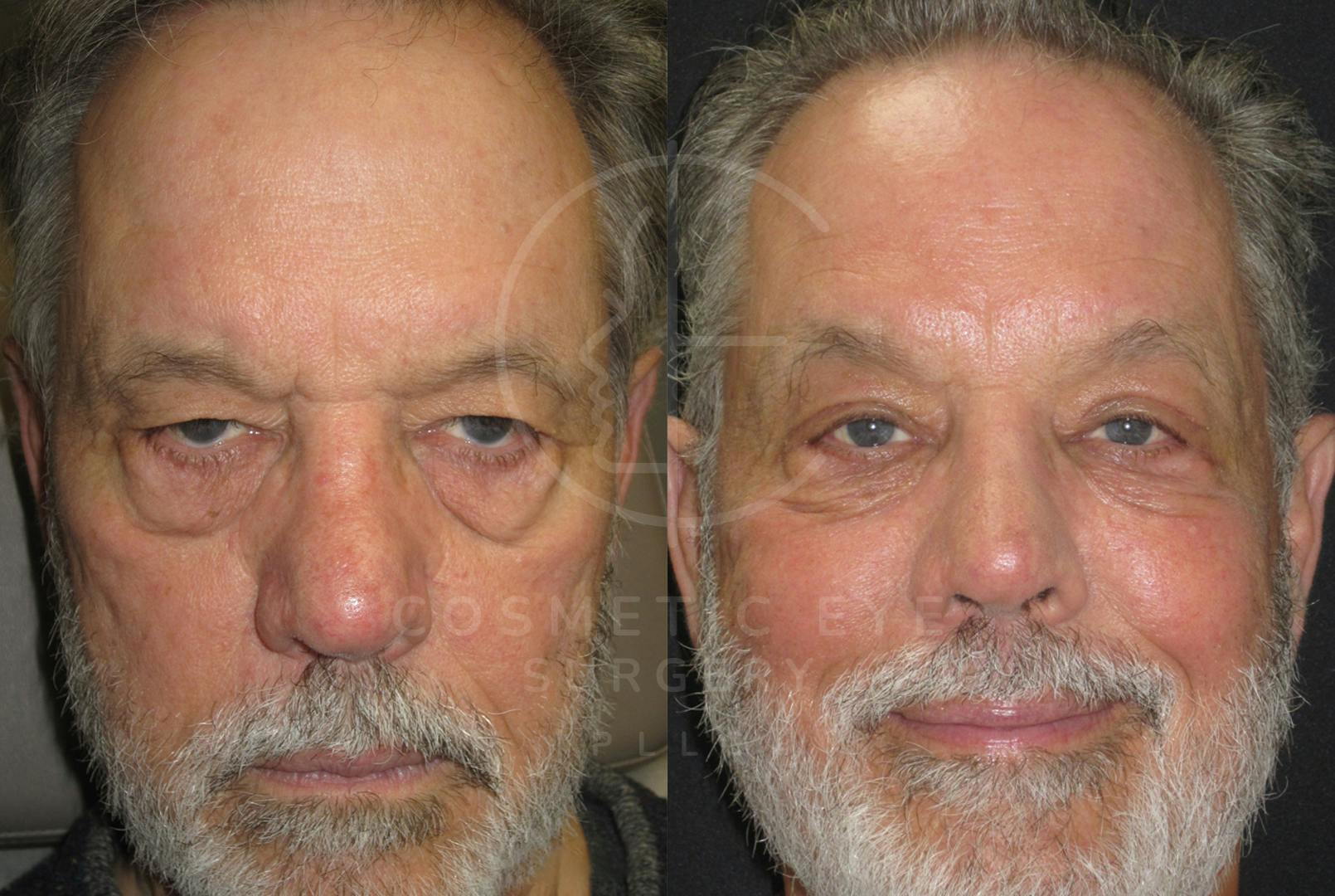 Male Lower Eyelids Ectropion Repair, Canthoplasty & Upper Bleph Patient Image #1