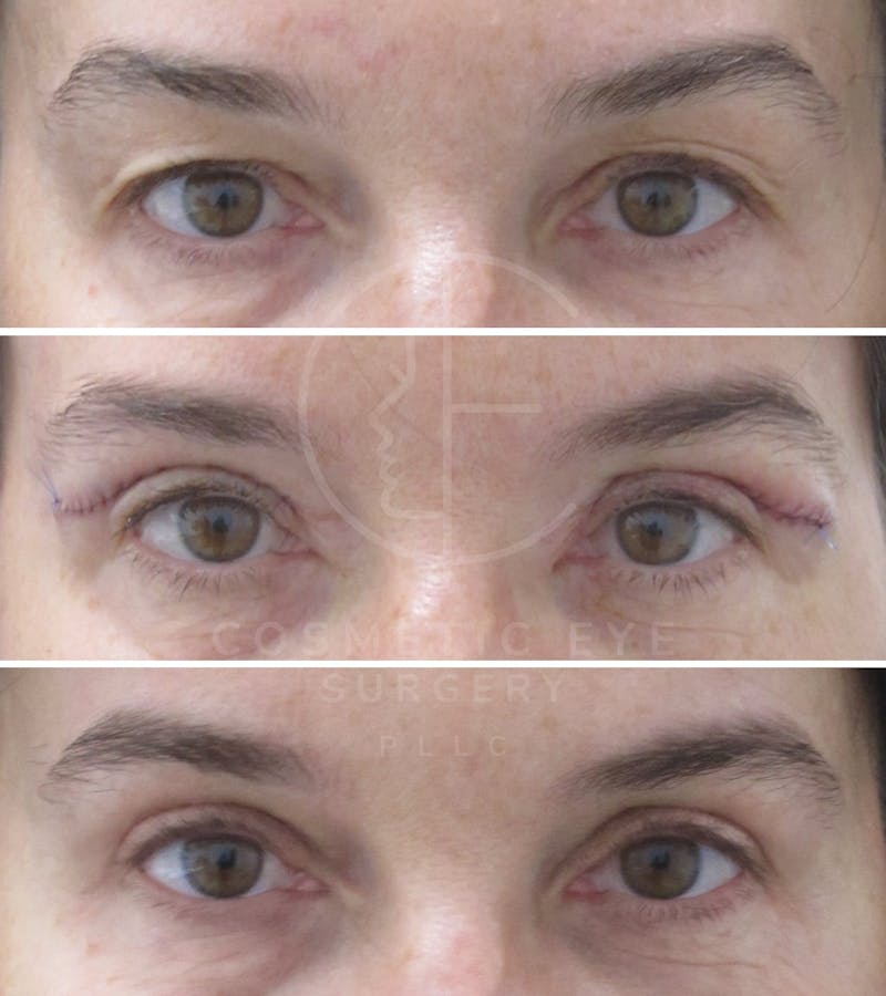 Cosmetic Eye Gallery Before & After Gallery - Patient 184082 - Image 3