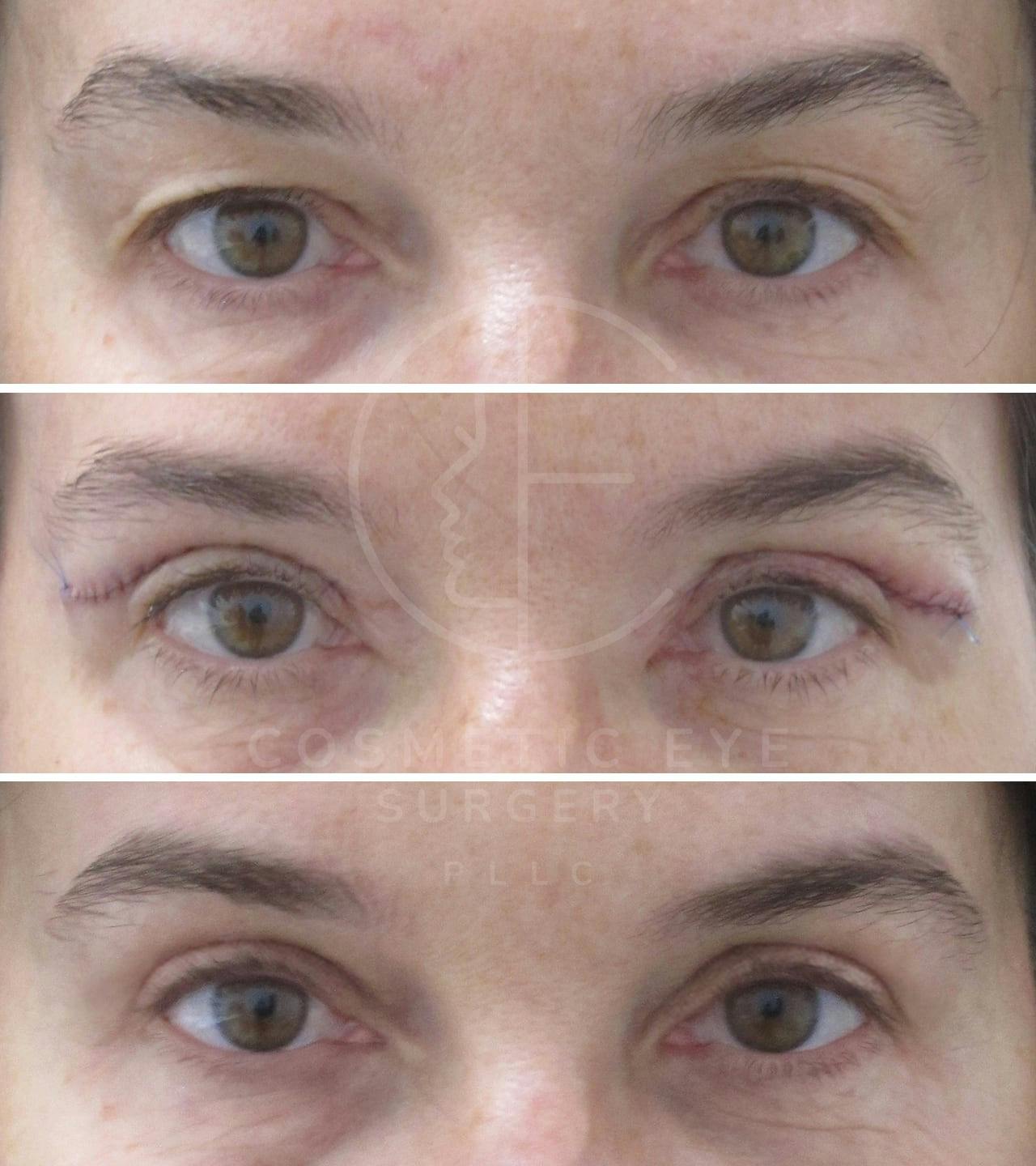 Upper Bhlepharoplasty for Assymetry Patient Image #3