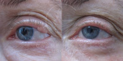 Cosmetic Eye Gallery Before & After Gallery - Patient 130714 - Image 1