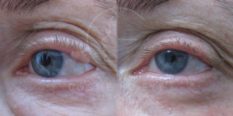 Cosmetic Eye Gallery Before & After Gallery - Patient 130714 - Image 1