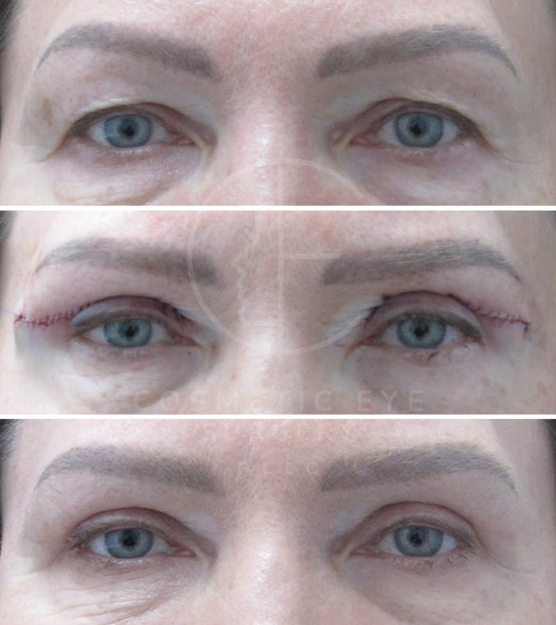 Cosmetic Eye Gallery Before & After Gallery - Patient 190251 - Image 3