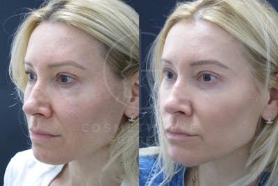 Cosmetic Eye Gallery Before & After Gallery - Patient 939912 - Image 1