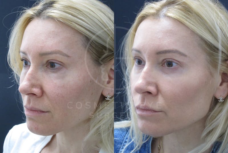 Cosmetic Eye Gallery Before & After Gallery - Patient 939912 - Image 1