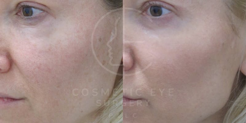 Cosmetic Eye Gallery Before & After Gallery - Patient 939912 - Image 2