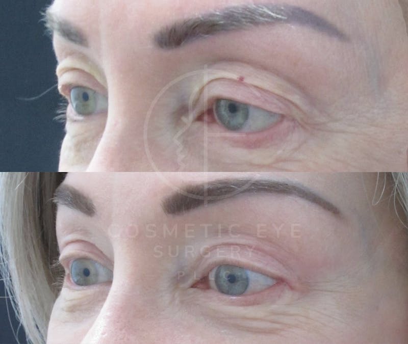 Cosmetic Eye Gallery Before & After Gallery - Patient 144256 - Image 2