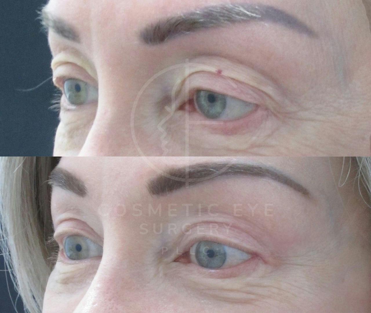 Revision Canthoplasty for Eyelid Retraction Patient Image #2