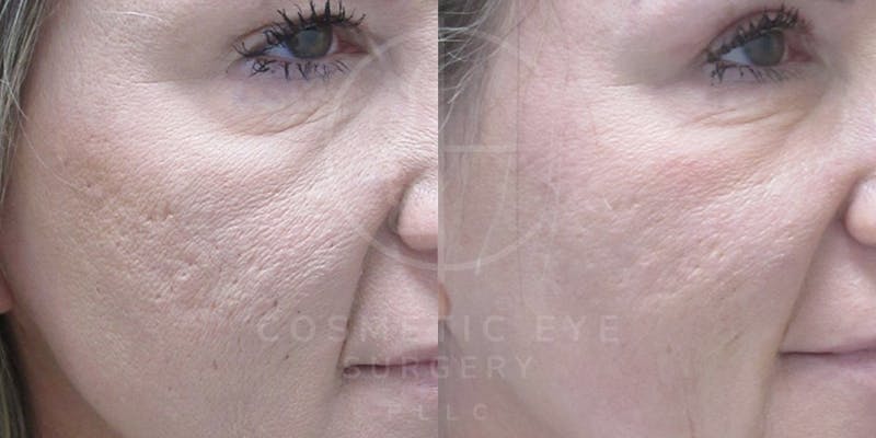 Cosmetic Eye Gallery Before & After Gallery - Patient 935675 - Image 1