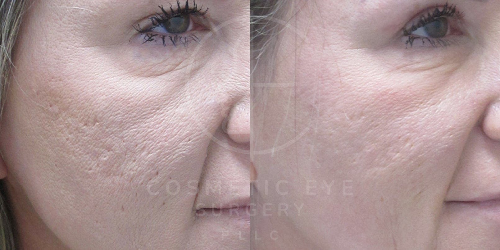 CO₂ LASER for Acne Scars Patient Image #1