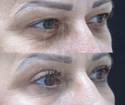 Cosmetic Eye Gallery Before & After Gallery - Patient 298729 - Image 2