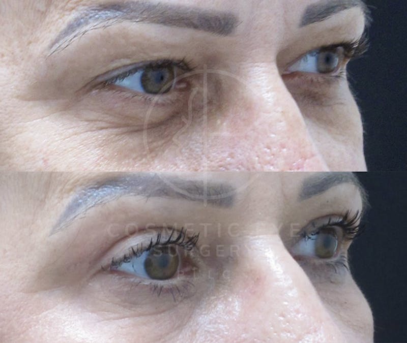 Cosmetic Eye Gallery Before & After Gallery - Patient 298729 - Image 2