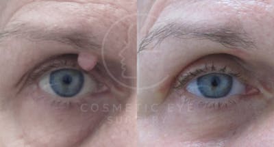 Cosmetic Eye Gallery Before & After Gallery - Patient 116346 - Image 1