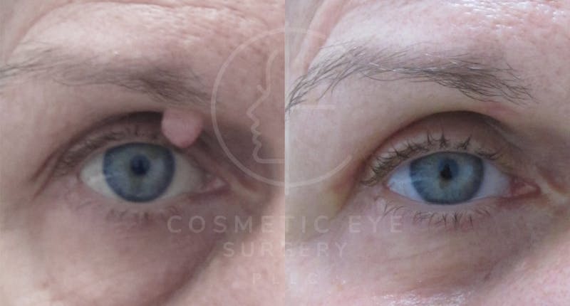 Cosmetic Eye Gallery Before & After Gallery - Patient 116346 - Image 1