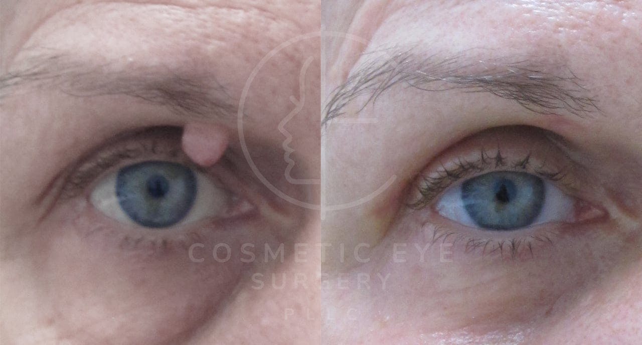 Eyelid Lesion Removal Patient Image #1