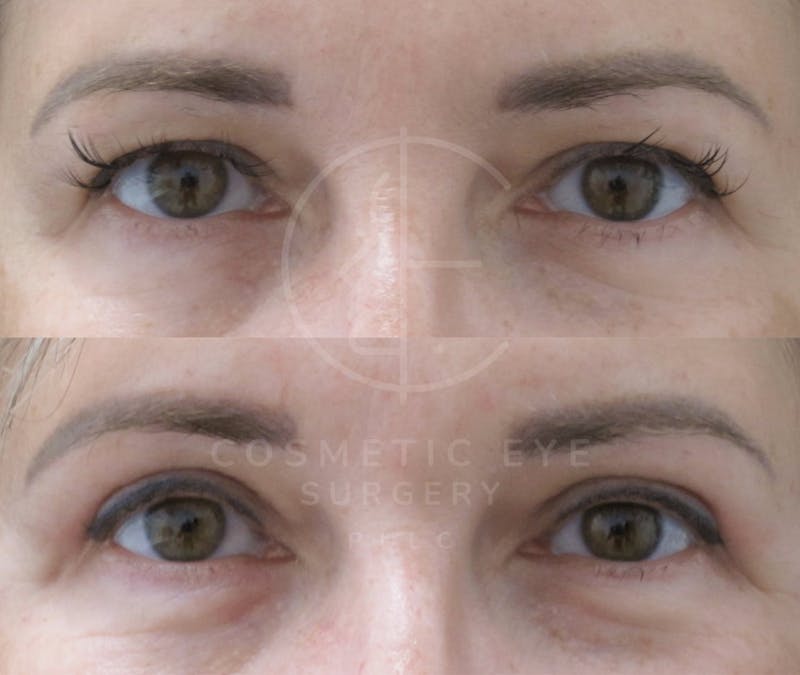 Cosmetic Eye Gallery Before & After Gallery - Patient 236044 - Image 3