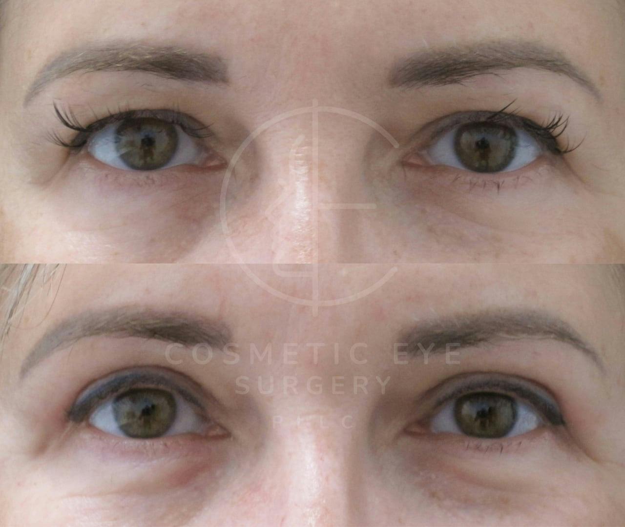 Upper Blepharoplasty for Concealed Permanent Eyeliner Patient Image #3
