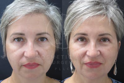 Cosmetic Eye Gallery Before & After Gallery - Patient 236044 - Image 2