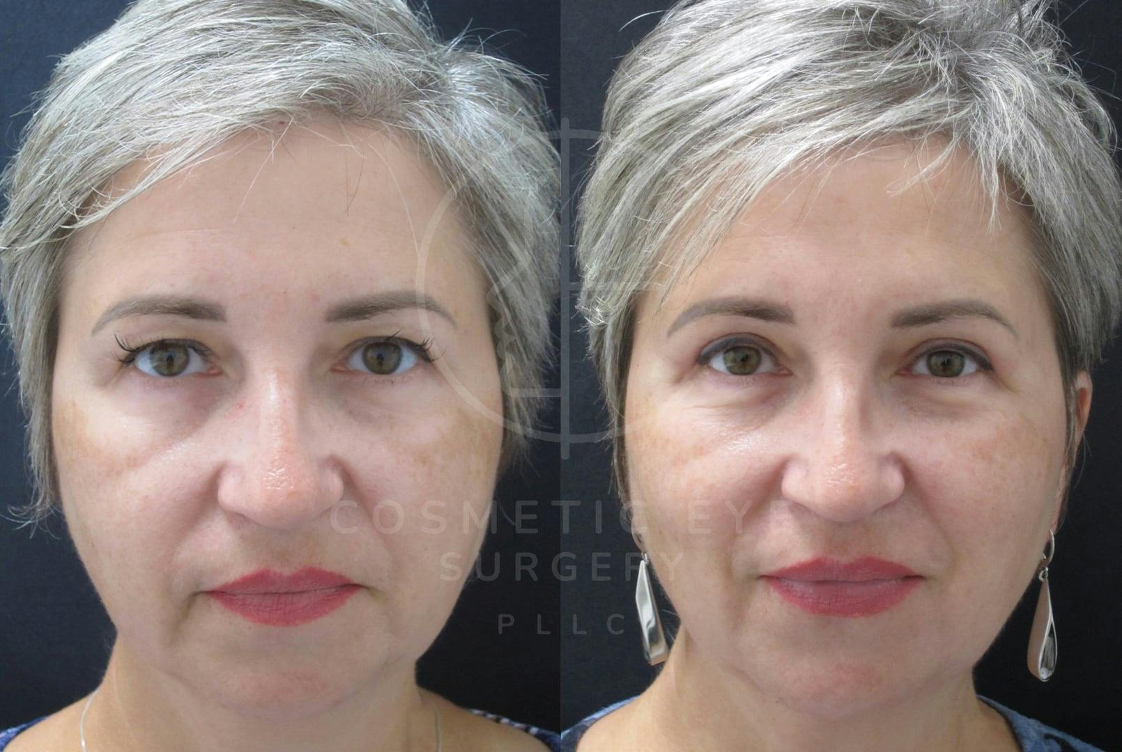 Upper Blepharoplasty for Concealed Permanent Eyeliner Patient Image #2