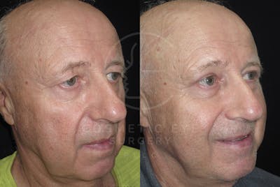 Cosmetic Eye Gallery Before & After Gallery - Patient 316354 - Image 1