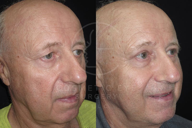 Cosmetic Eye Gallery Before & After Gallery - Patient 316354 - Image 1