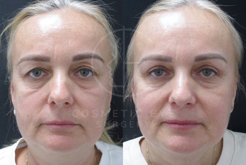 Cosmetic Eye Gallery Before & After Gallery - Patient 159843 - Image 3