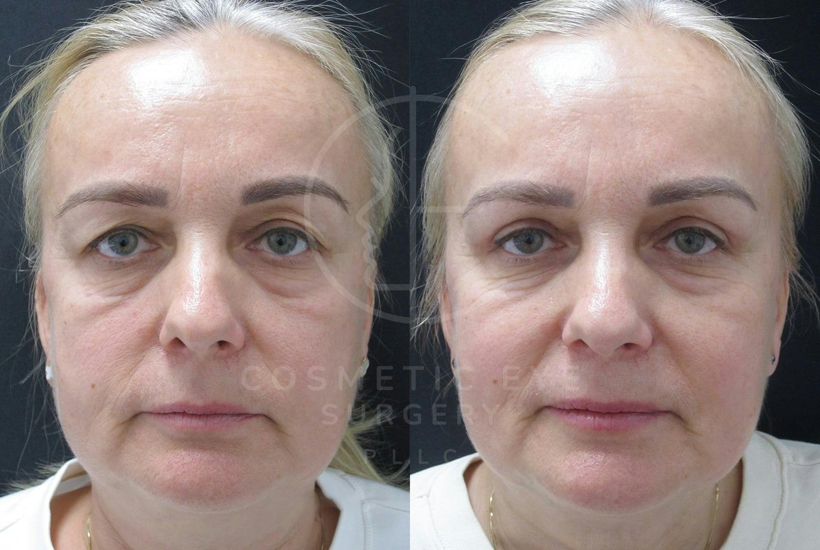 Upper Eyelid Surgery for Asymmetry Patient Image #3