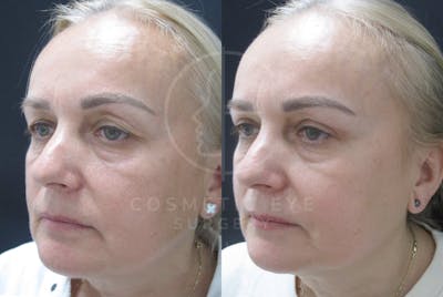 Cosmetic Eye Gallery Before & After Gallery - Patient 159843 - Image 2