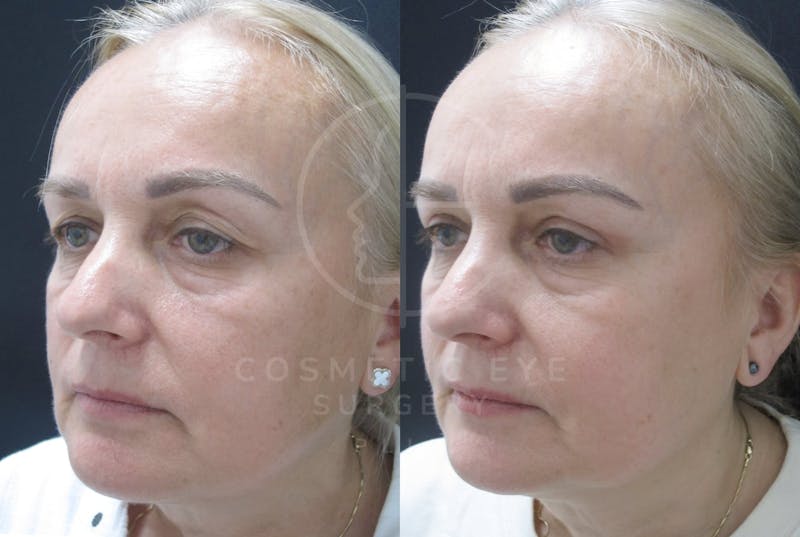 Cosmetic Eye Gallery Before & After Gallery - Patient 159843 - Image 2