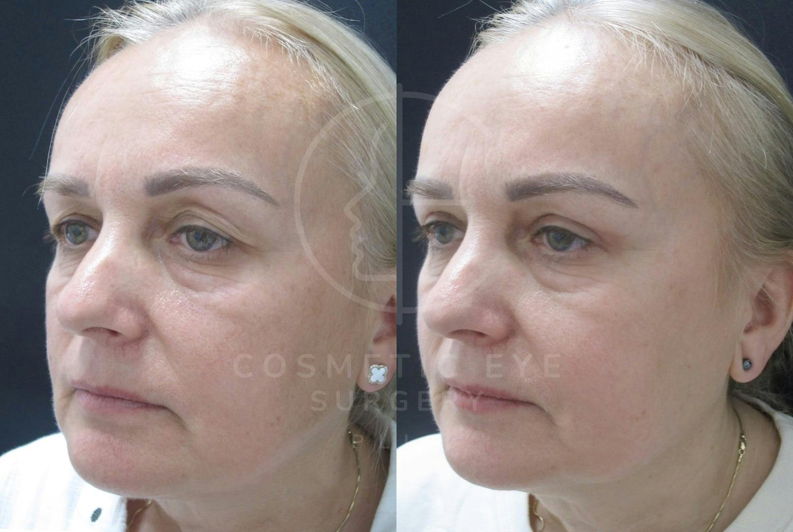 Upper Eyelid Surgery for Asymmetry Patient Image #2