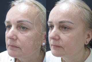Cosmetic Eye Gallery Before & After Gallery - Patient 159843 - Image 2