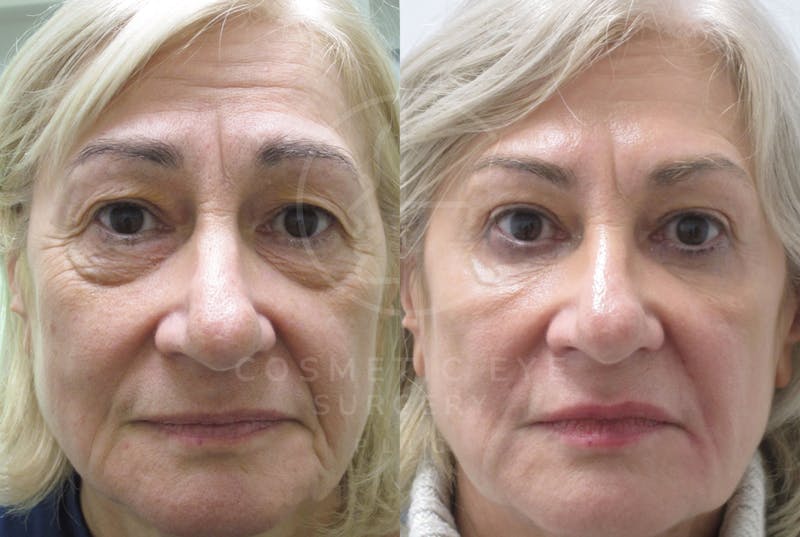 Cosmetic Eye Gallery Before & After Gallery - Patient 397373 - Image 1