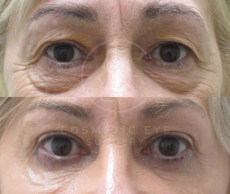 Cosmetic Eye Gallery Before & After Gallery - Patient 397373 - Image 2