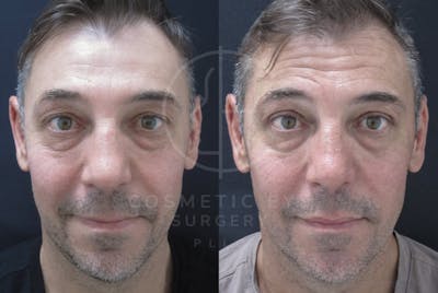 Cosmetic Eye Gallery Before & After Gallery - Patient 128045 - Image 2