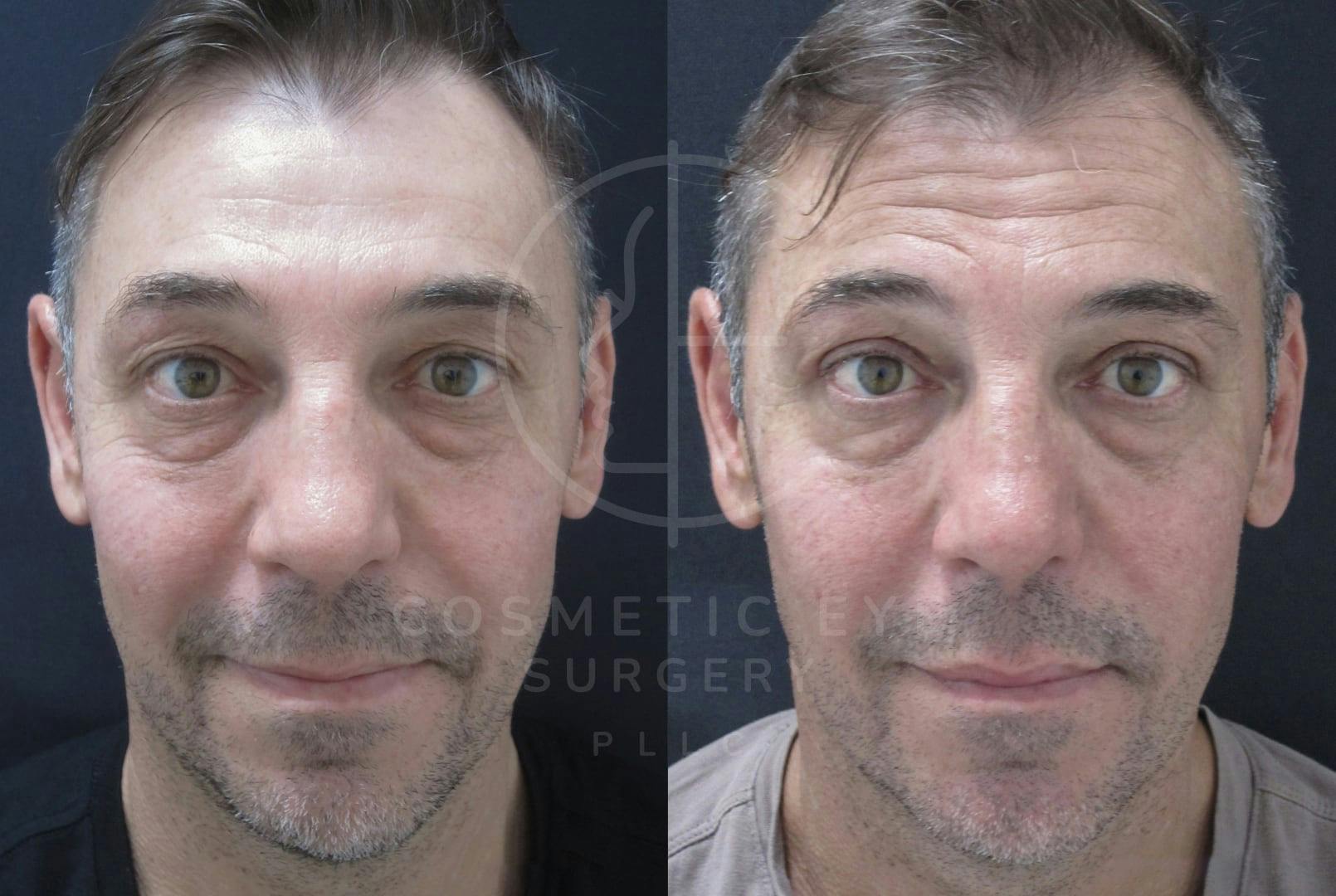 Upper Eyelid Surgery for Men Patient Image #2
