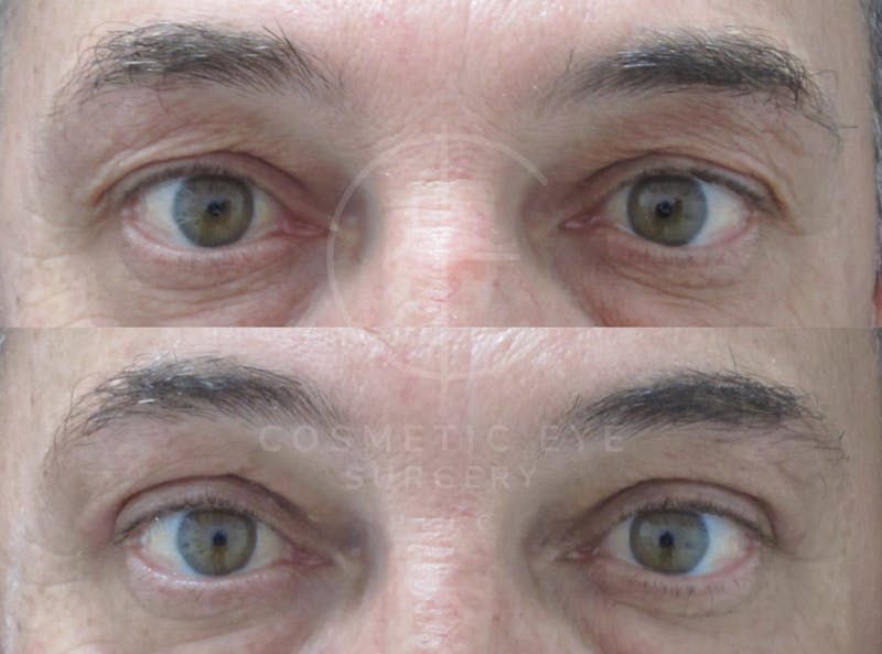 Cosmetic Eye Gallery Before & After Gallery - Patient 128045 - Image 3