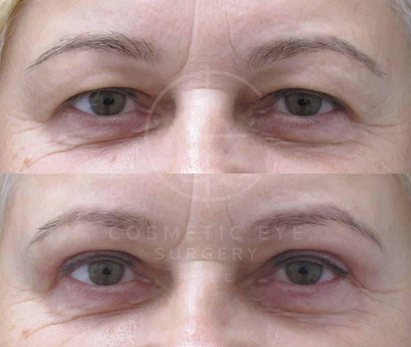 Cosmetic Eye Gallery Before & After Gallery - Patient 688703 - Image 2