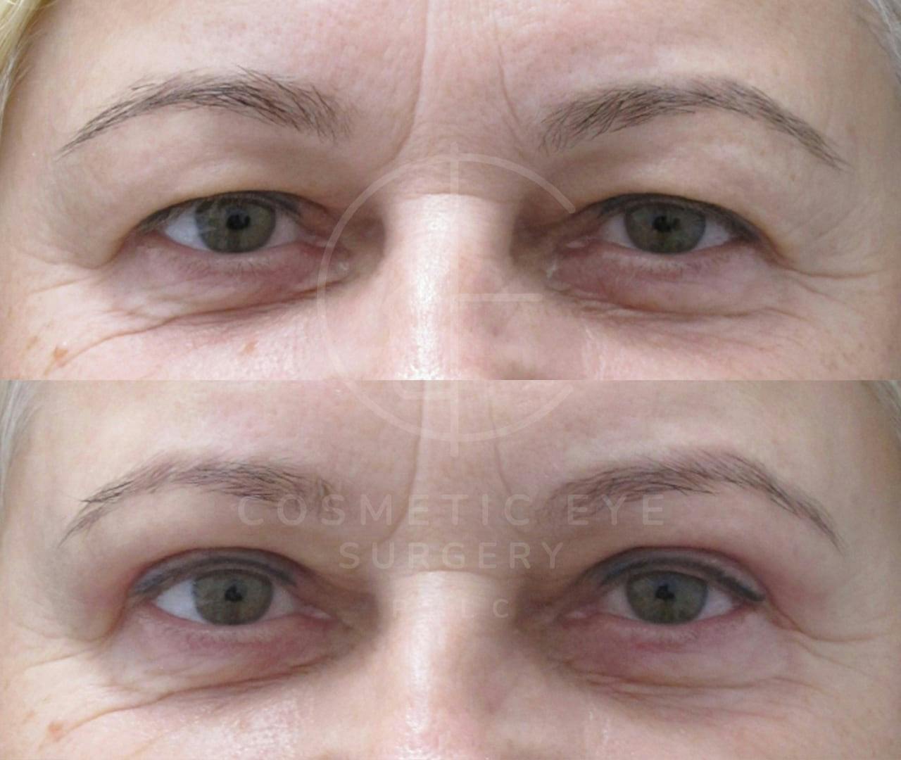 Upper Blepharoplasty Patient Image #2