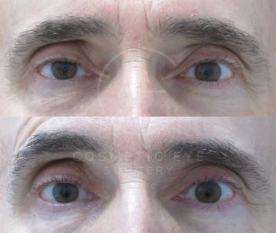 Cosmetic Eye Gallery Before & After Gallery - Patient 215818 - Image 1