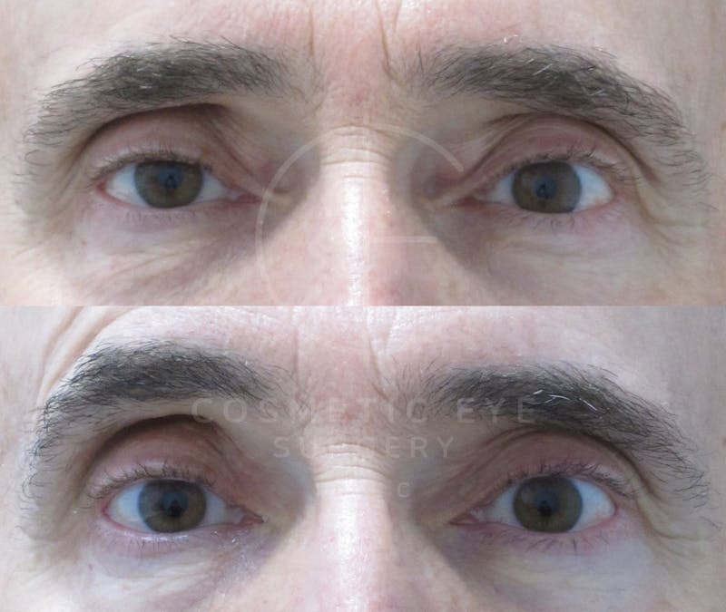 Cosmetic Eye Gallery Before & After Gallery - Patient 215818 - Image 1