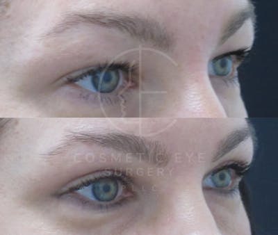 Cosmetic Eye Gallery Before & After Gallery - Patient 655155 - Image 2